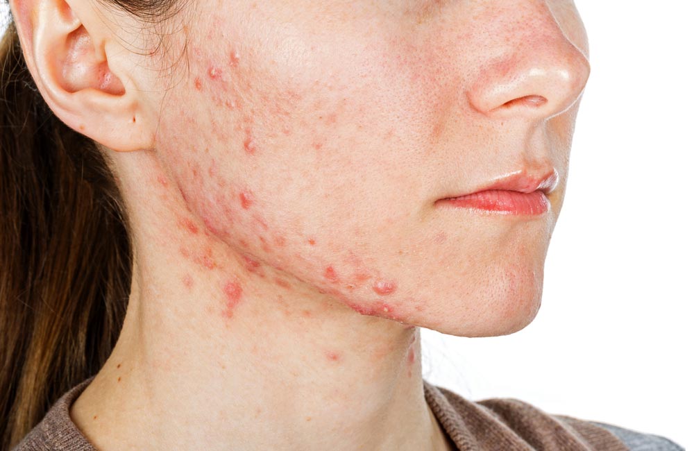 #Masdermo2019 Mitos sobre la Isotretinoína en acné moderado o severo