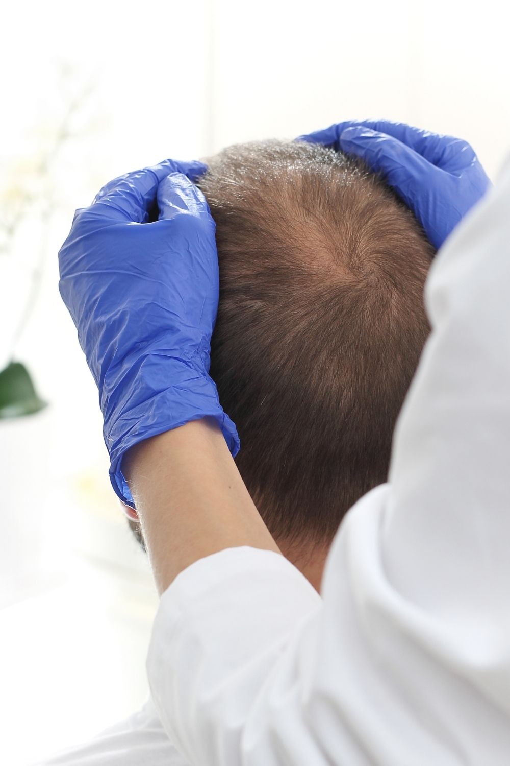 clinica sara carrasco alopecia