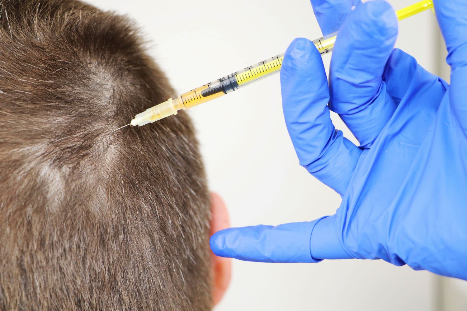 Alopecia androgénica masculina: Causas, diagnóstico y tratamiento