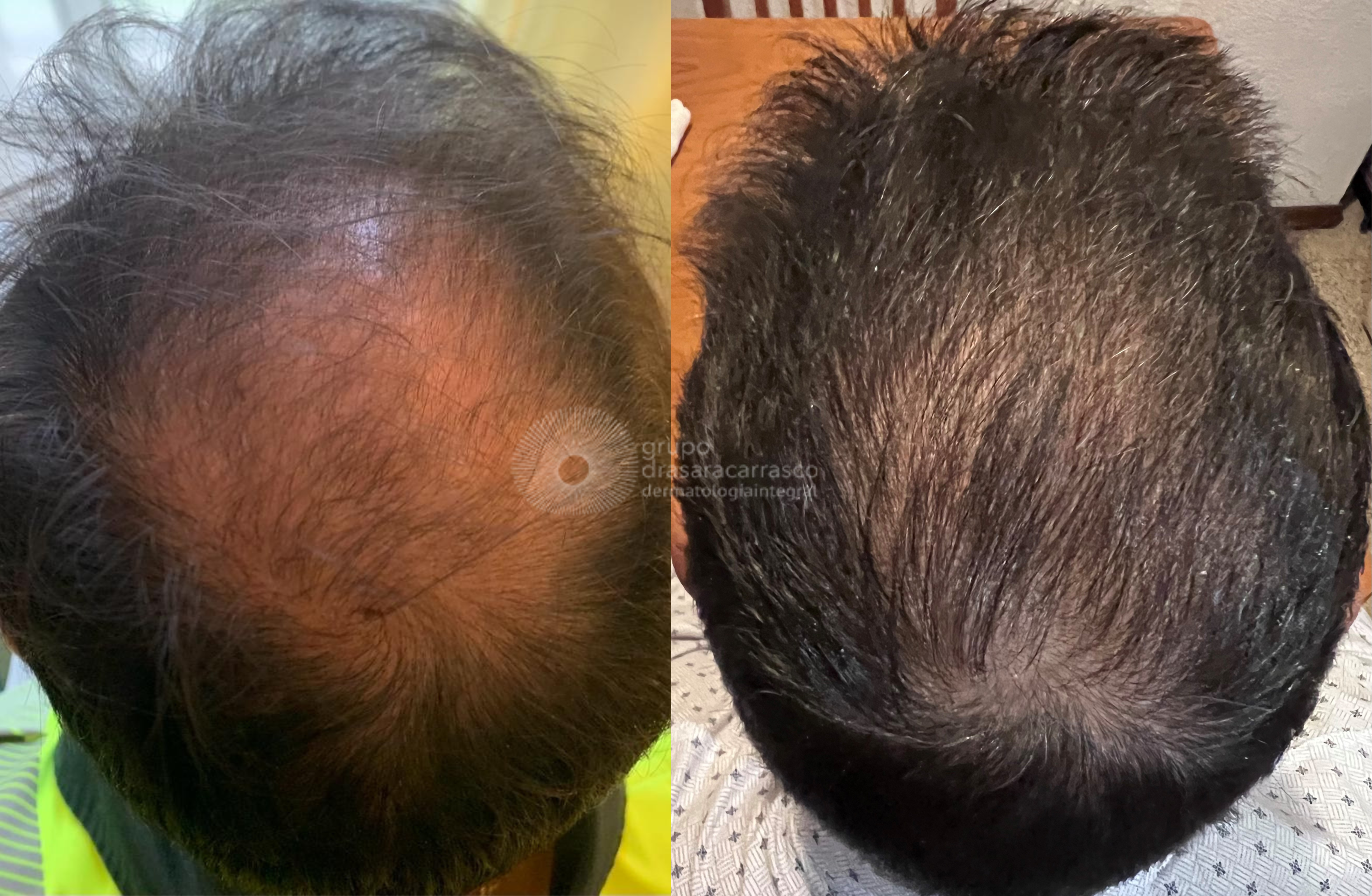 antes y despues alopecia bilbao