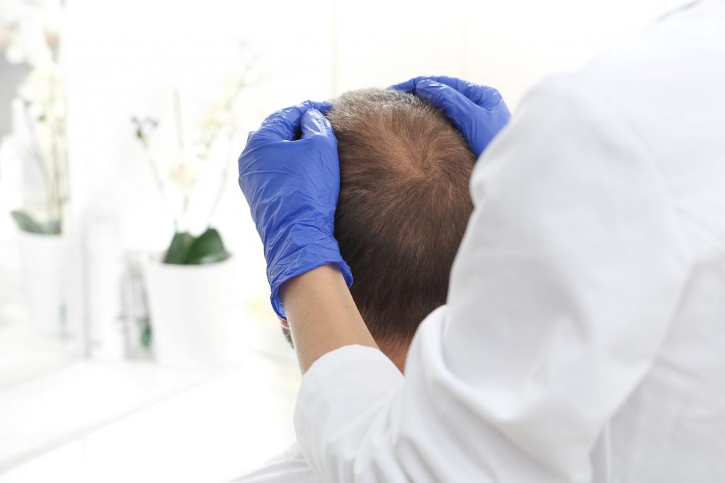 tratamiento calvicie alopecia androgenica bilbao