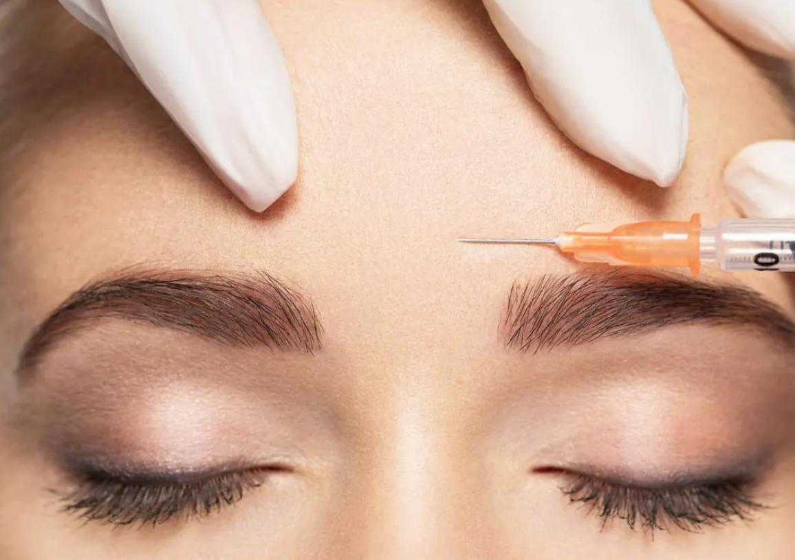 Bótox preventivo: por qué las jóvenes de 30 se inyectan contra las arrugas